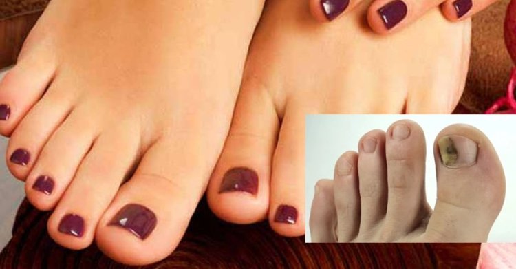 toenail fungus : infected toenail with fungus 